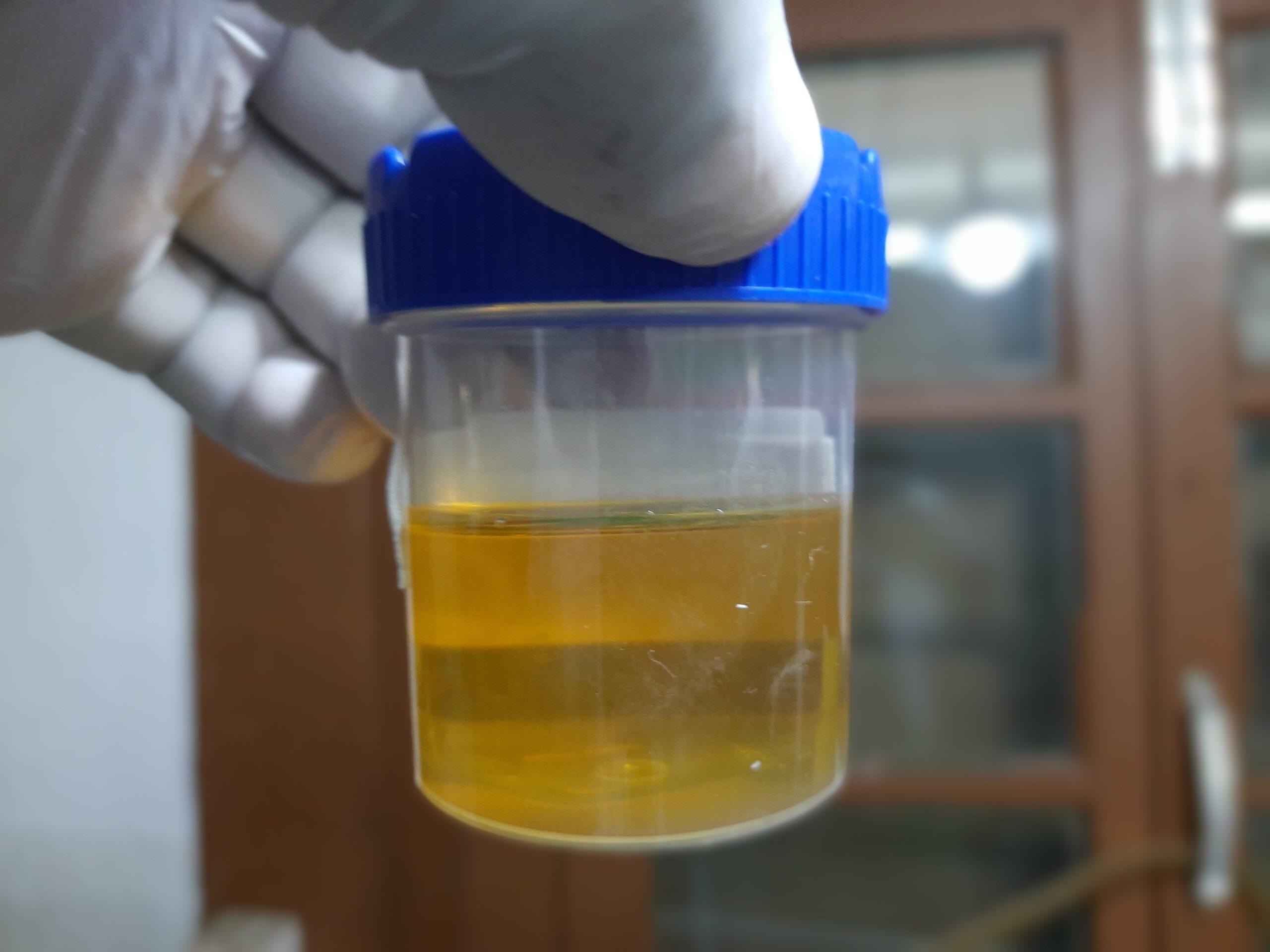 Brain tumour can be detected through urine
